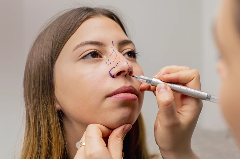 Profissional desenha marcações com caneta cirúrgica no nariz de uma jovem durante o planejamento